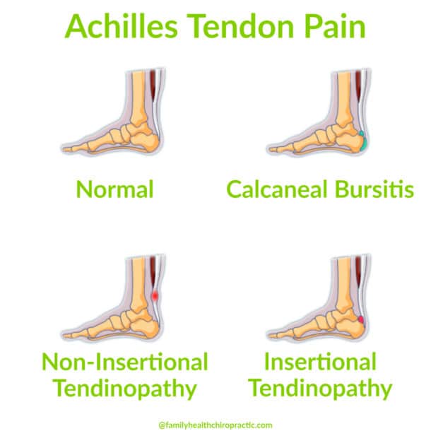 Achilles Tendon Pain: Causes, Symptoms and Treatment