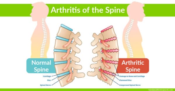 Austin Chiropractor | Can Chiropractic Help Neck Arthritis?