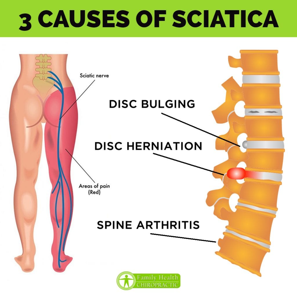 Austin Chiropractor Sciatica Treatment In Austin Texas